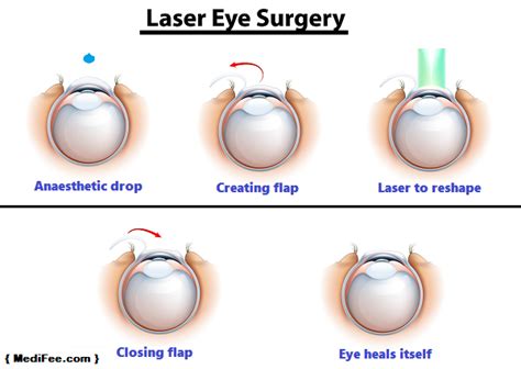 Laser Eye Treatment in India - Risks, Cost and Procedure