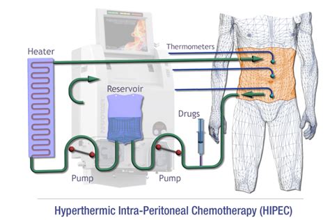 Hyperthermic Intraperitoneal Chemotherapy