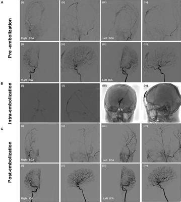 Frontiers Case Report Endovascular Treatment Of Two Scalp