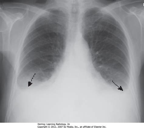 Pleural Diseases Pleural Effusion Pneumothorax Flashcards Quizlet