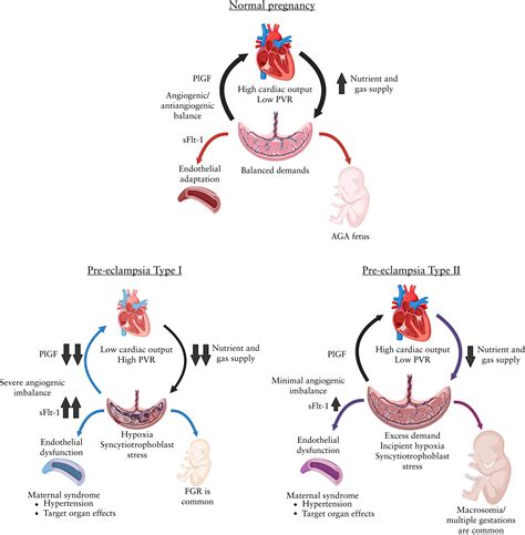 Redefining Preeclampsia As Type I Or Ii Implementing An Integrated