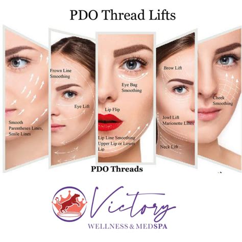 Pdo Thread Lift Smooths The Cheeks Frown Lines Eye Lift Lip Lift