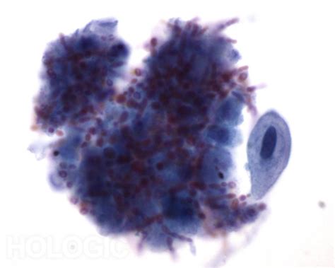 Candida Cytology