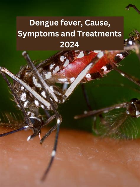 Dengue Fever Cause Symptoms And Treatments Goodsandbad