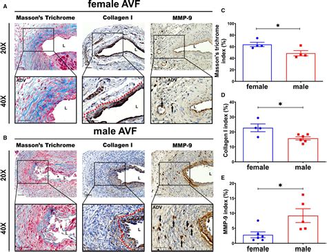 Differences In Transforming Growth Factor‐β1 Bmp7 Signaling And Venous Fibrosis Contribute To