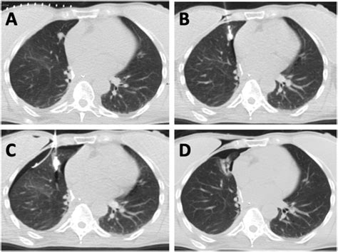 Primary And Metastatic Lung Cancer Rationale Indications And Outcomes Of Thermal Ablation