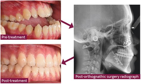 What Is Orthognathic Surgery