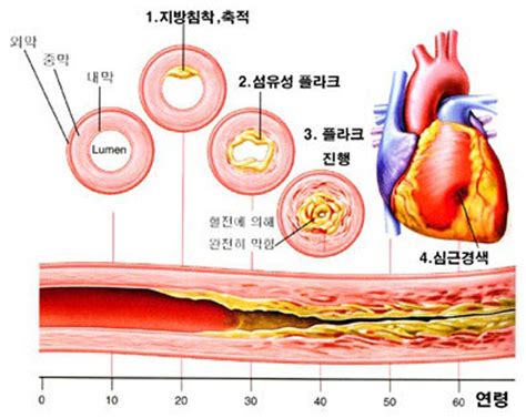 급성심근경색 초기증상 동맥경화증 진행단계 네이버 블로그