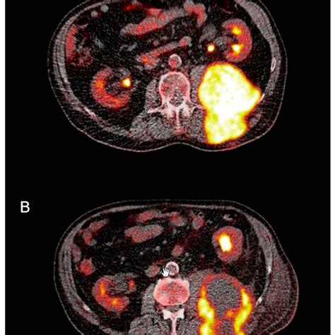 Transaxial Fludeoxyglucose F Positron Emission Tomography Computed