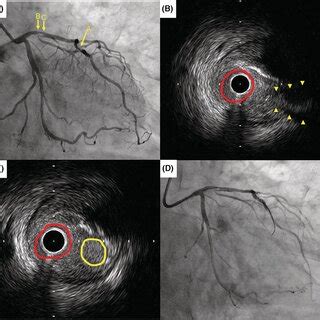 Fluoroscopic And Ivus Images Following Atherectomy A The Dca