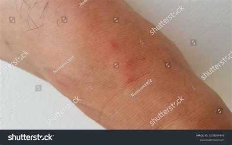 Blisters On Legs After Ant Bite Stock Photo 2238299145 Shutterstock