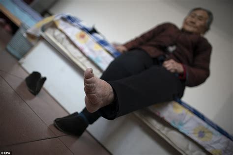 Grandmother Uncovers Her Deformed Bound Feet Which Were Supposed To