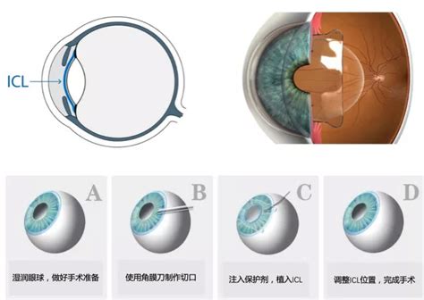 Icl 有晶状体眼人工晶状体植入术手术方式屈光中心