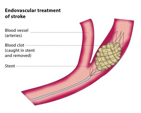 Endovascular Treatment Of Stroke Cirse