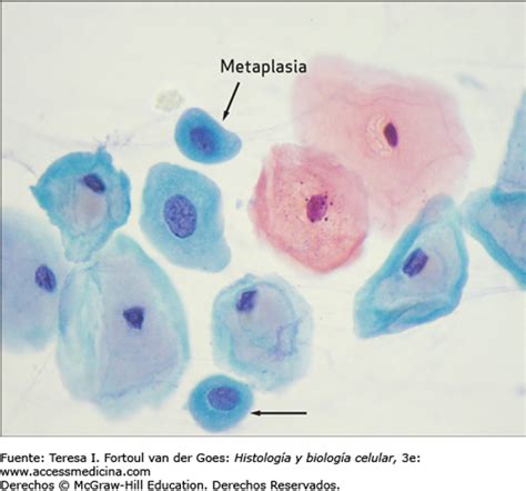 Citomorfología de la metaplasia escamosa en citología ginecológica