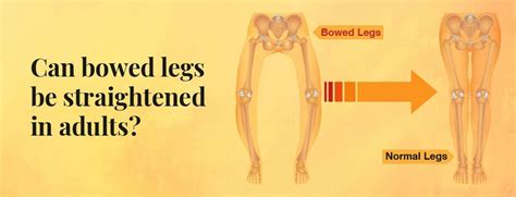 Knock Knees Causes, Treatment and Best Exercises - 2023