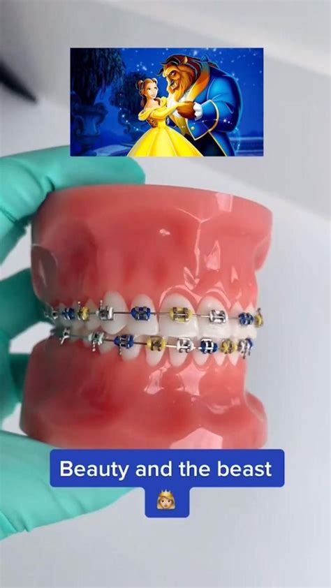 Braces Color Combinations To Enhance Your Smile Healthy Lifestyle Health Aesthetic Denti