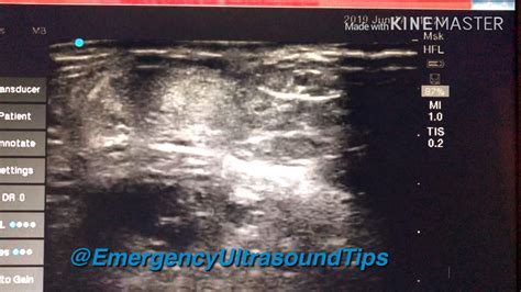Ruptured Achilles Tendon Ultrasound by Emergency Ultrasound Tips