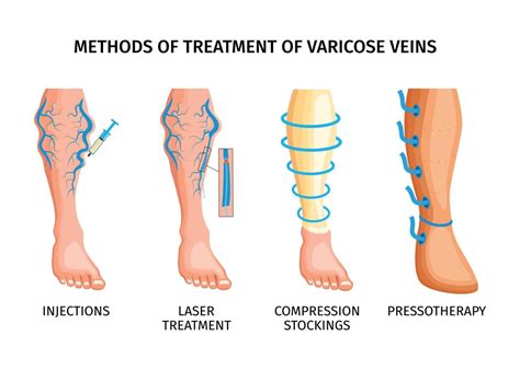 Methods Of Treatment Of Varicose Veins 12696795 Vector Art at Vecteezy