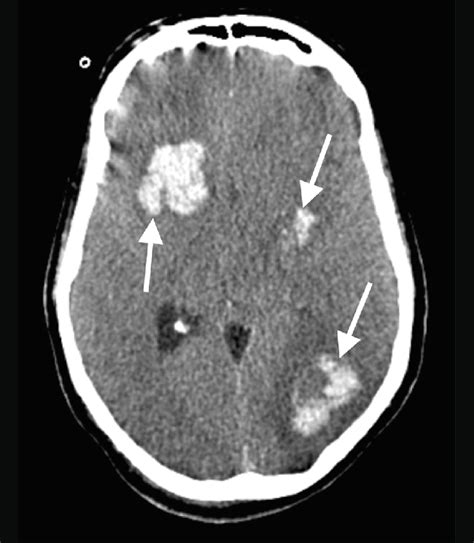 Case 5 Brain CT Of A 49 Year Old Man With COVID 19 Showing Multiple