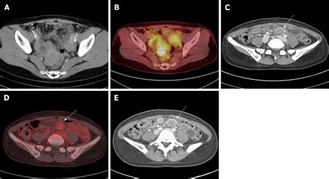 Figure 1 From Intra Abdominal Desmoid Tumors Mimicking Gastrointestinal Stromal Tumors — 8 Cases