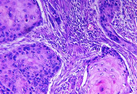 Squamous Cell Carcinoma Of Ear And Temporal Bone Ent Doctor Ear And