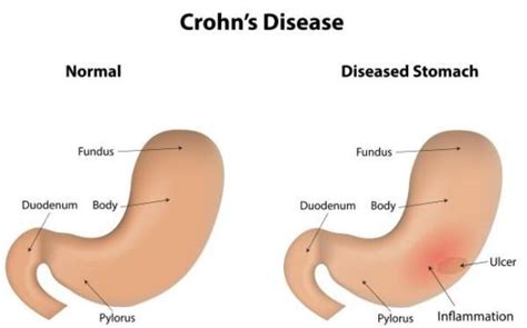 9 Nursing Diagnosis Related To Crohn S Disease Nursing Care Plan