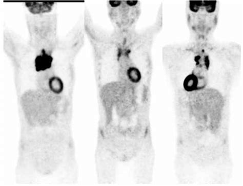 A Series Of Pet Fdg Scans Showing Hodgkin Lymphoma Therapy Monitoring