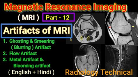 MRI Part 12 Artifacts Of MRI Ghosting Smearing Artifact Flow