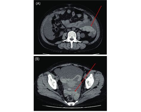 Abdominal Pelvis Ct Scan Of Patient Taken After 29 Hours Of First Ct Download Scientific