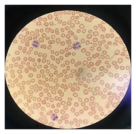 Peripheral Smear Showing Hypersegmented Neutrophils Consistent With