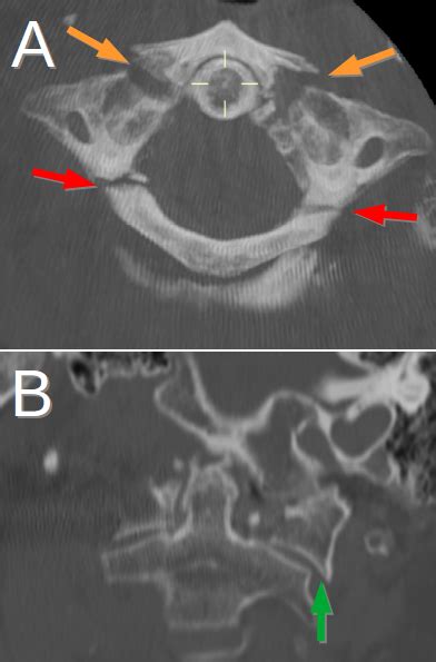 Type 2 Jefferson Fracture with Vertebral Dissection