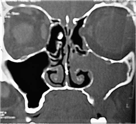 Left Maxillary Sinusitis Total Opacification With Blockage Of The