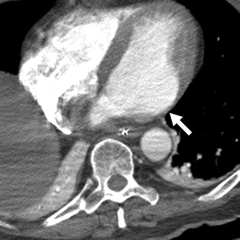 Incidental Myocardial Infarct On Conventional Nongated Ct A Review Of