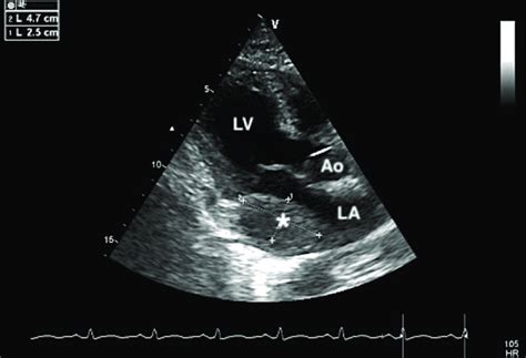 Modified Parasternal Long Axis Transthoracic Echocardiogram