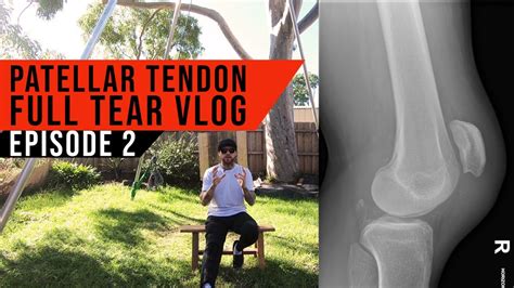 Ricky Crompton Vlog Ep 2 Patellar Tendon Full Tear The Diagnosis 2020 Patella Tendon