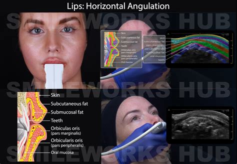 Mastering Lip Filler Injection Techniques A Comprehensive Guide