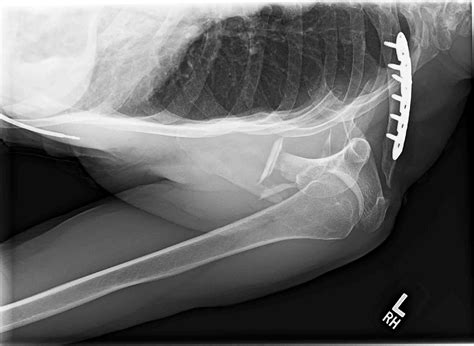 Ortho Dx Shoulder Pain Following A Bicycle Accident Clinical Advisor