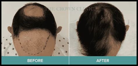 10 Surprising Causes Of Hair Loss Melbourne Hair Clinic