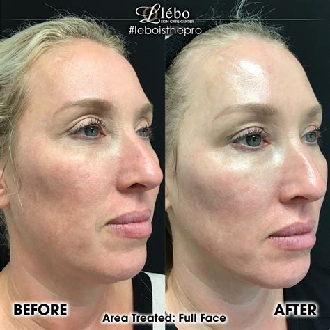 Skinvive By Juv Derm L Bo Aesthetics Spa York Hanover Pa