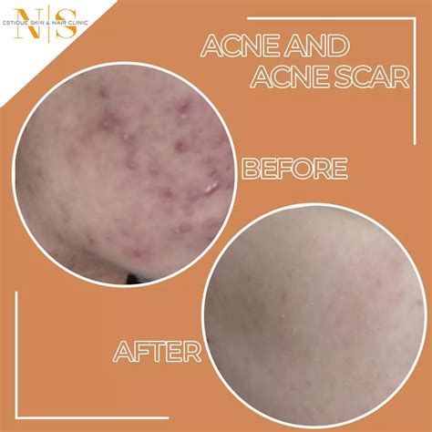 Estique Clinic Best Acne Scar Treatment In Gurgaon Acne Treatment