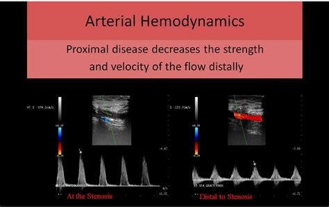 Lower Extremity Arterial Ultrasound Radiology