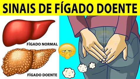 10 Sinais de FÍGADO Doente YouTube em 2020 Remedios para o figado