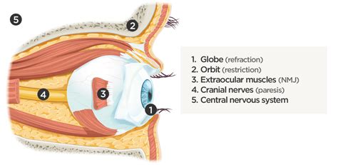 Differential Diagnosis Of Diplopia Applied