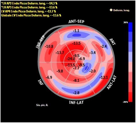 Bull Eye Depicting Longitudinal Strain Of The Lv By Speckle Tracking