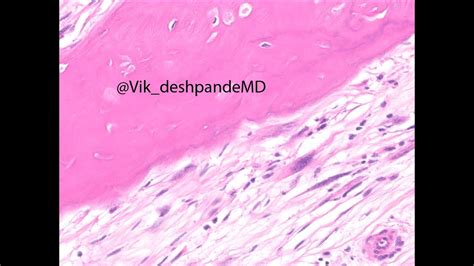 Parosteal Osteosarcoma With A Dedifferentiated Component Youtube