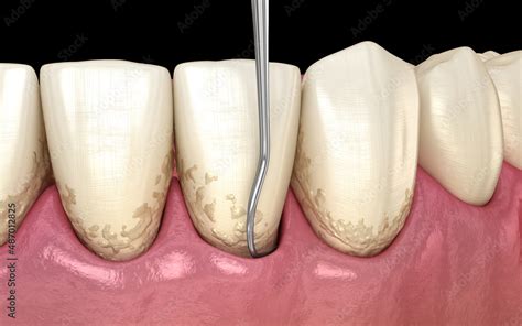 Oral Hygiene Scaling And Root Planing Conventional Periodontal