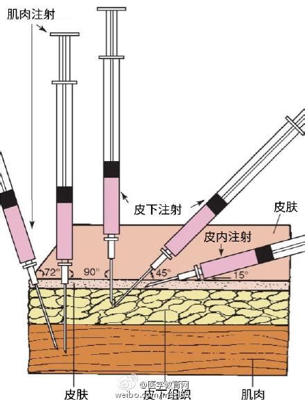 護士必學十種靜脈穿刺新方法，太全了！ 每日頭條