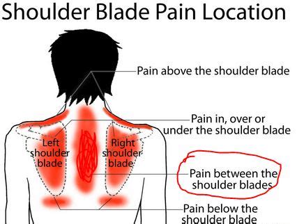 Pain Between Shoulder Blades Causes Treatment