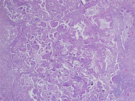 Micropapillary Adenocarcinoma Of The Lung Recent Updates And